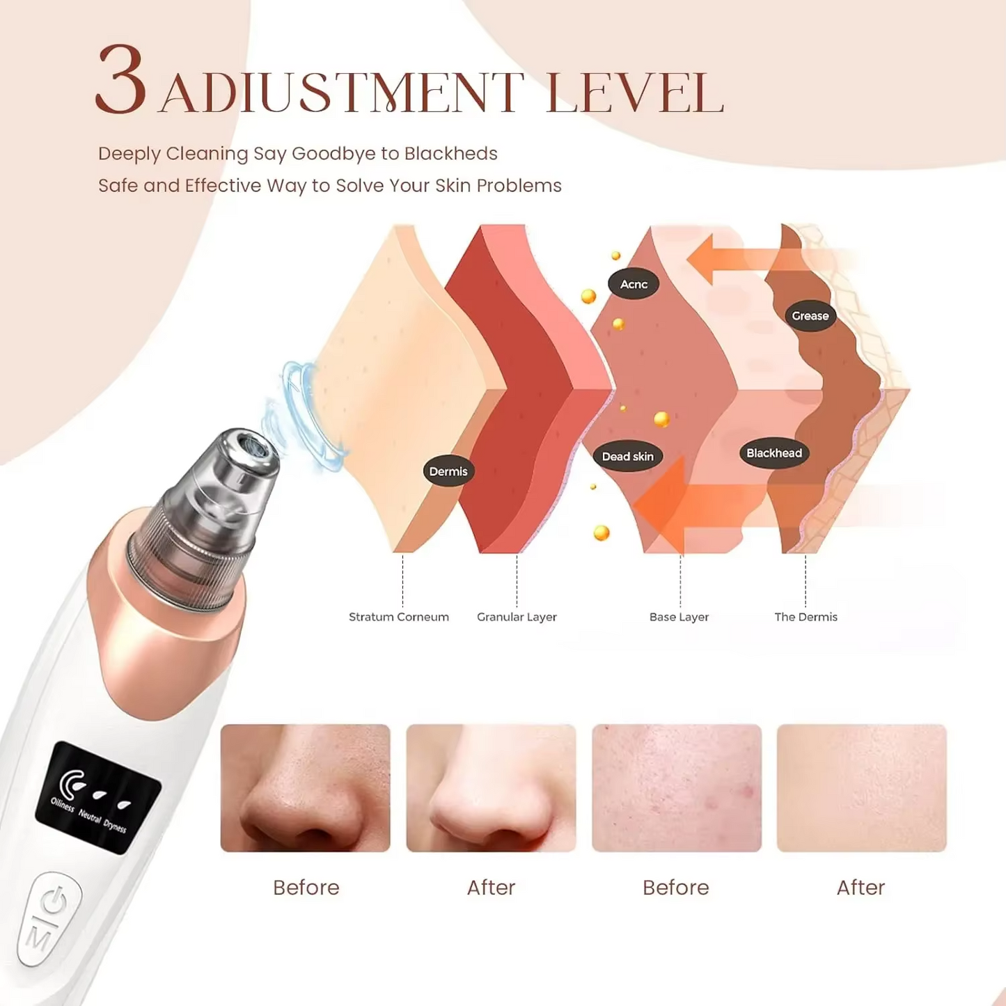 Lunea® Blackhead Remover